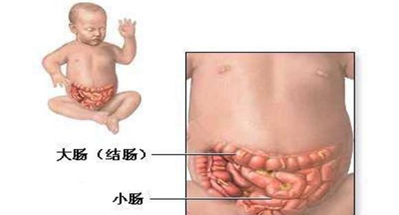 什么是柿石症