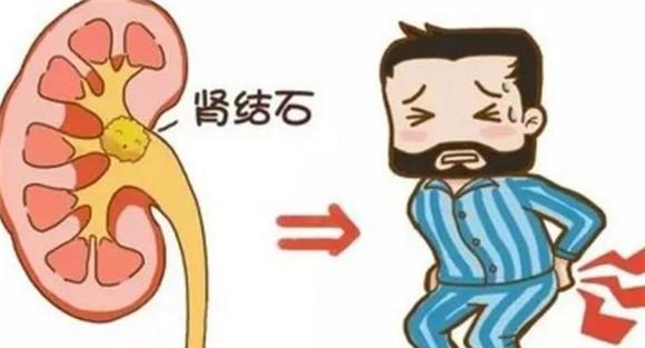 肾结石多在夏季形成
