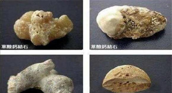 肾结石的种类如何划分
