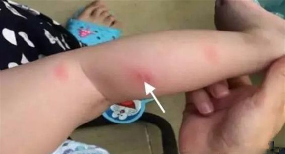 隐翅虫皮炎治疗方法