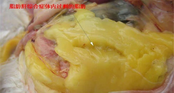 脂肪肝综合症